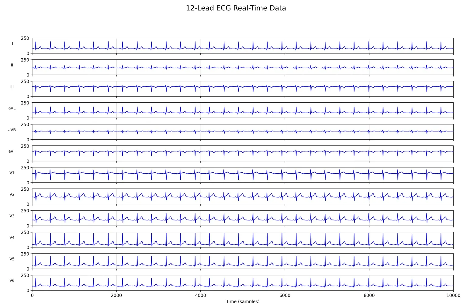 All twelve ECG lead lanes rendered simultaneously on the calibrated grid from the synthetic source