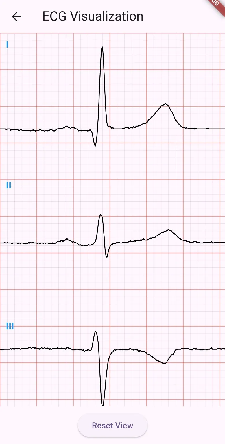 Live ECG capture showing leads I, II, and III on the calibrated grid